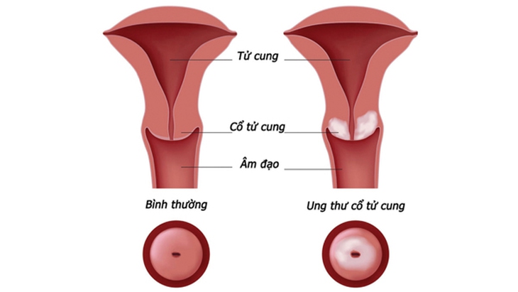5 bệnh ở tử cung dẫn đến vô sinh
