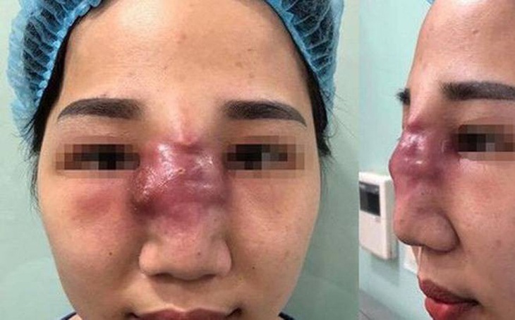 Tai biến nặng nề do tiêm filler làm đẹp