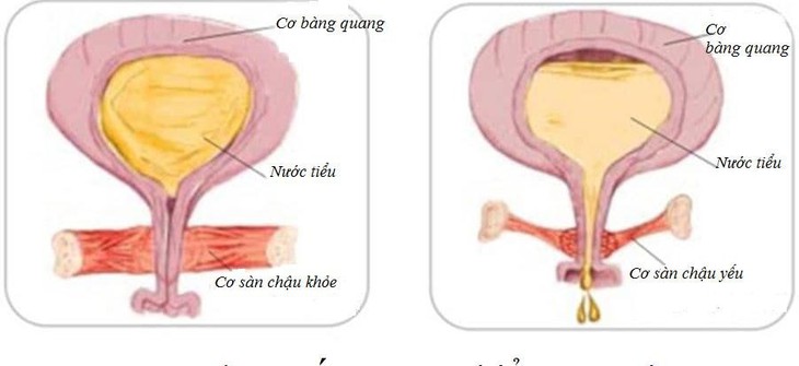 Chứng tiểu nhiều lần 