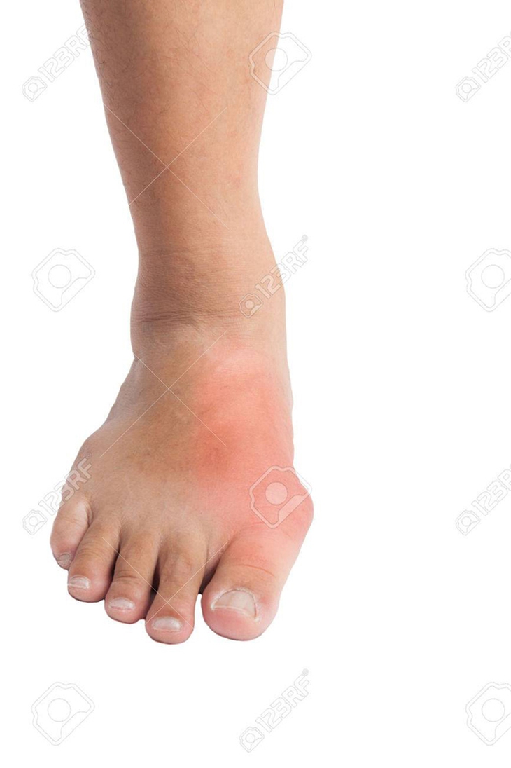 Bạn bị bệnh gút 
