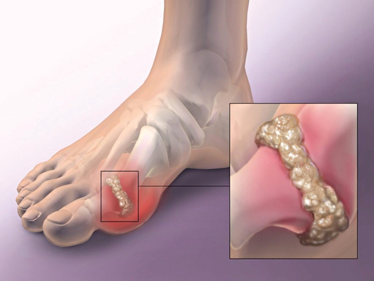 Bạn bị bệnh gút