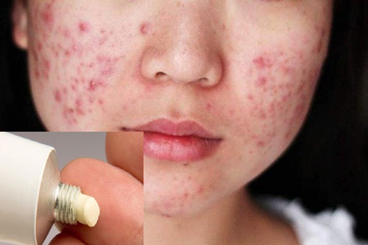 Các thuốc không được lạm dụng khi trị trứng cá đỏ