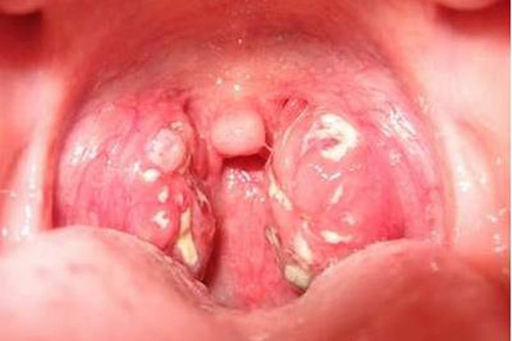 Chọn thuốc chữa viêm họng “hạt” nhanh khỏi