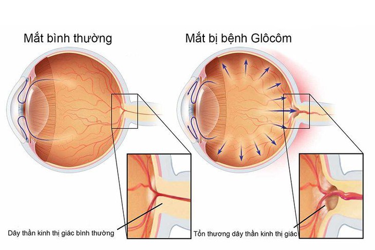 Đau nhức mắt