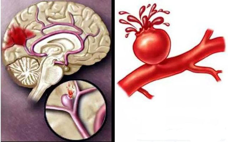 Phòng ngừa tai biến mạch máu não cho người bệnh tăng huyết áp