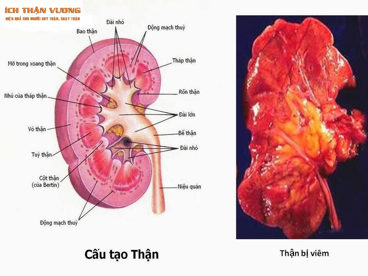 Viêm cầu thận cấp