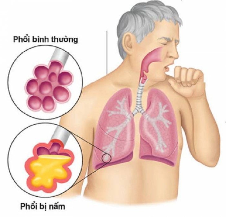 Nhiễm nấm phổi khi mắc cúm A, một người nguy kịch- Ảnh 3.