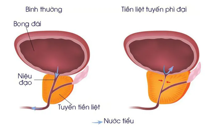 Thuốc trị u xơ tiền liệt tuyến: Những bất lợi cần lưu ý