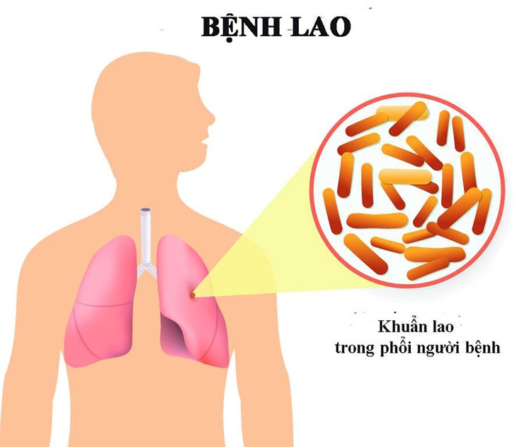 Các bệnh dễ nhầm với lao phổi