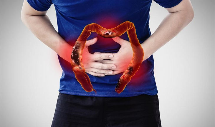 Bài thuốc trị chứng đại tràng thấp nhiệt