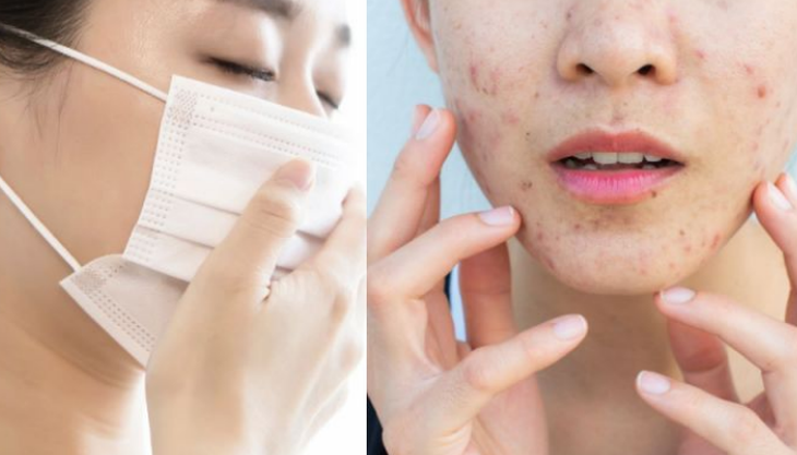 Xử lý trục trặc ở da do đeo khẩu trang kéo dài