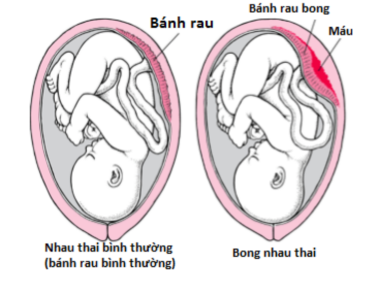 Mẹ bầu cần biết về bánh nhau bất thường