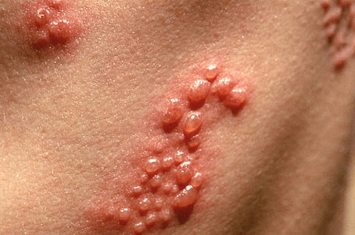 Mủ chuối xanh có trị được giời leo?