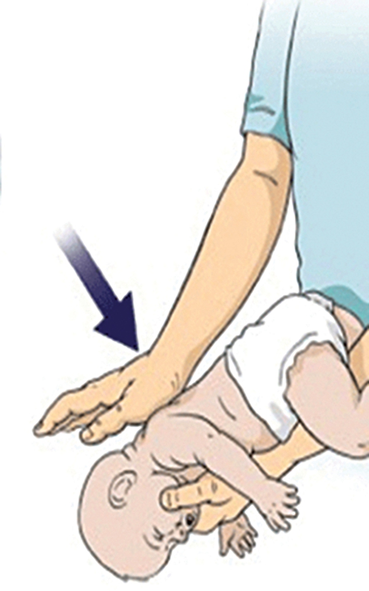 Sơ cứu cấp cứu sặc sữa ở bé sơ sinh