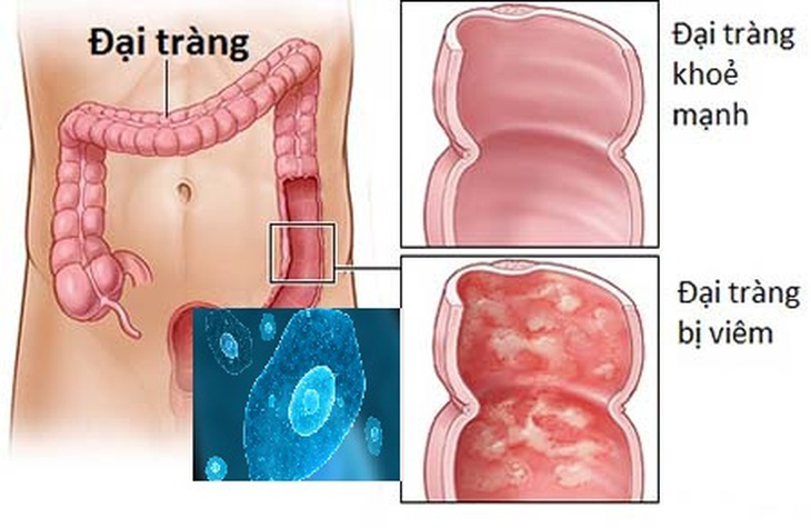 Thuốc trị viêm đại tràng do amip
