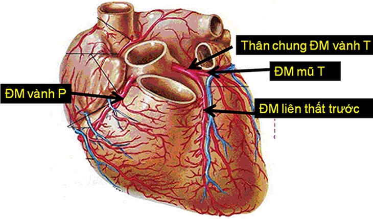 Bệnh động mạch vành