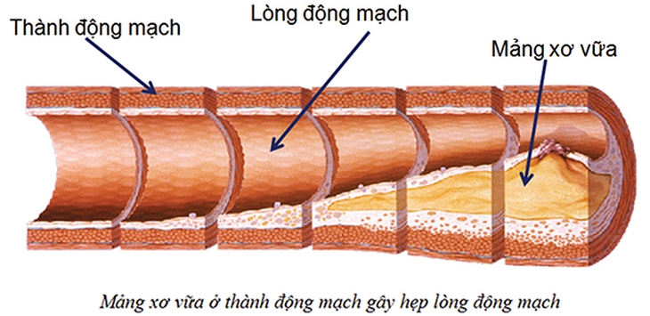 Bệnh động mạch vành