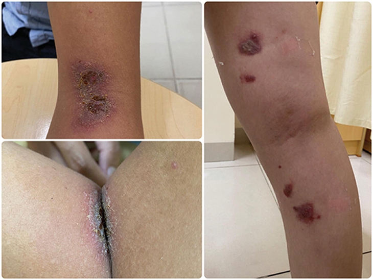 Viêm da tiếp xúc  kích ứng do kiến ba khoang