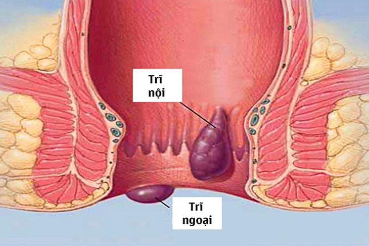 Điều trị thiếu máu  do bệnh trĩ bằng y học cổ truyền