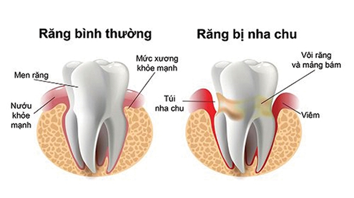 Nỗi phiền toái mang tên viêm nha chu