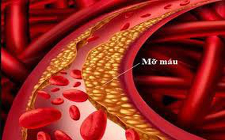 Tăng mỡ máu