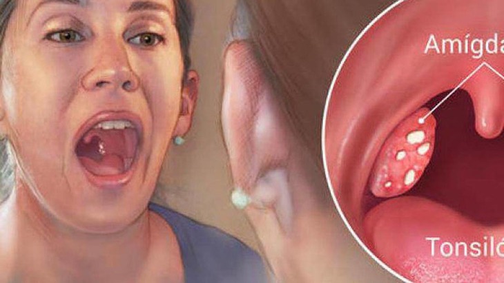 Viêm amidan ở người lớn