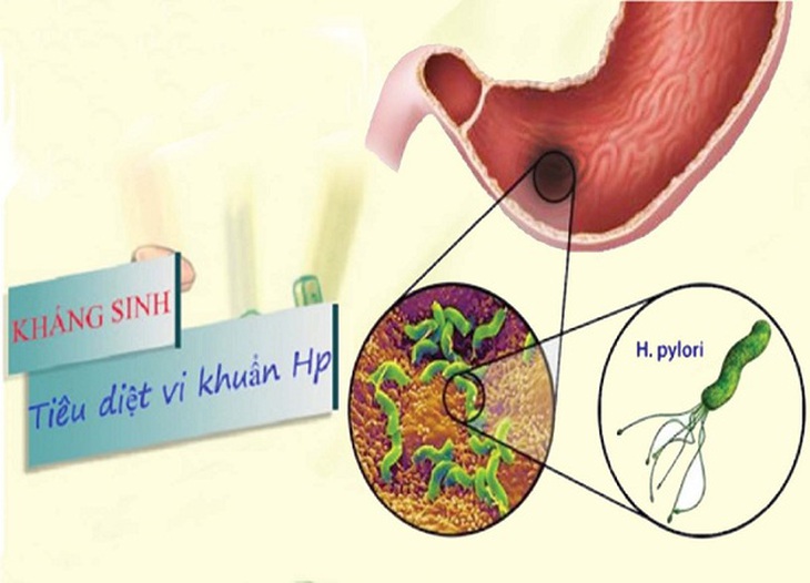Vi khuẩn H.Pylori 