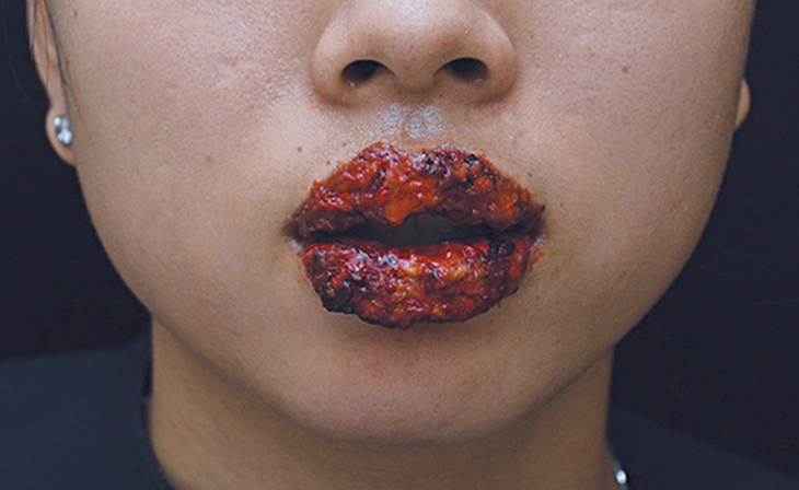 Biến chứng xăm môi