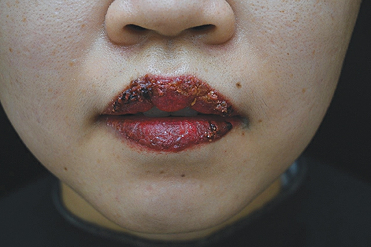 Biến chứng xăm môi