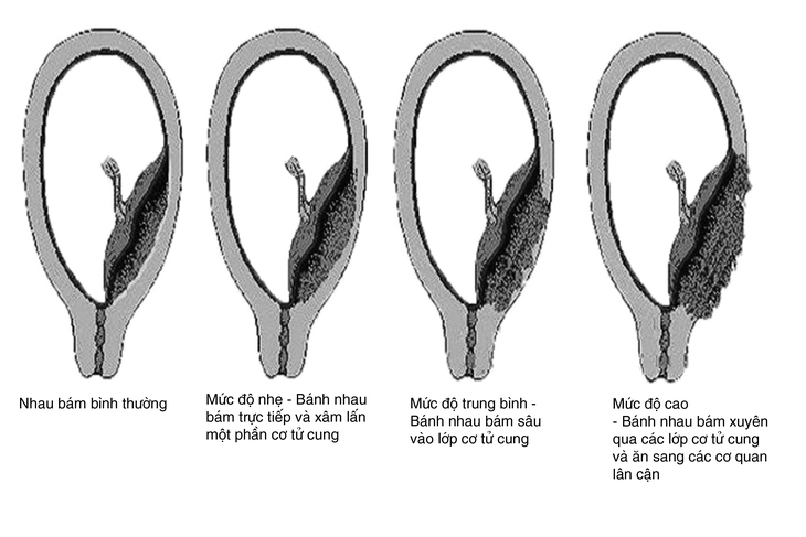 Nhau cài răng lược