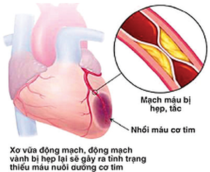 Bệnh tim mạch