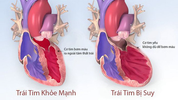 suy tim mạn tính