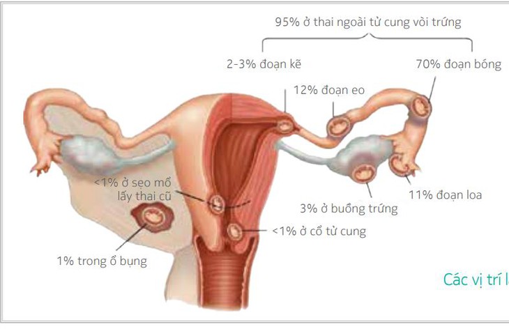 Thai bám sẹo mổ 