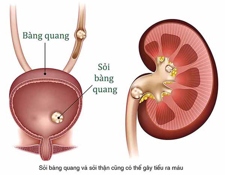 Tiểu máu