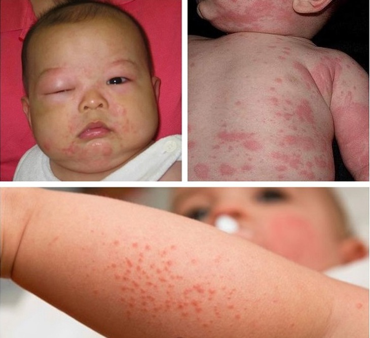 dị ứng thời tiết