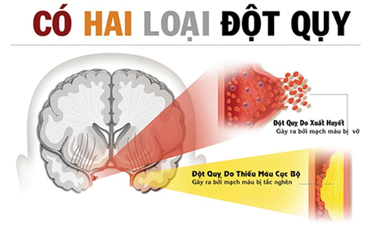 đột quỵ