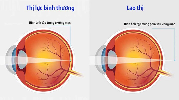 bệnh mắt