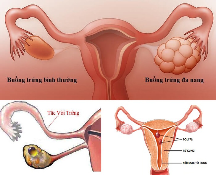 vô sinh, hiếm muộn