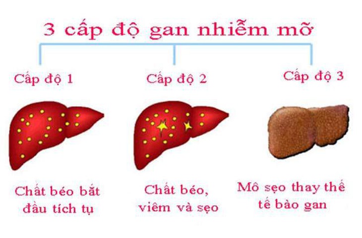 viêm gan