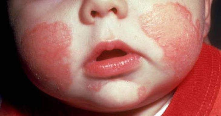  eczema 