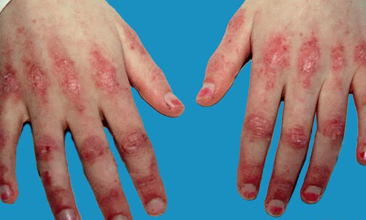 Nhận diện các tổn thương viêm da cơ và viêm đa cơ 