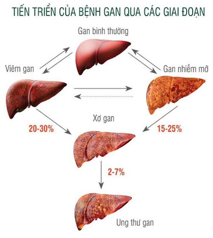 Xơ gan bị chảy máu thực quản có nguy hiểm?