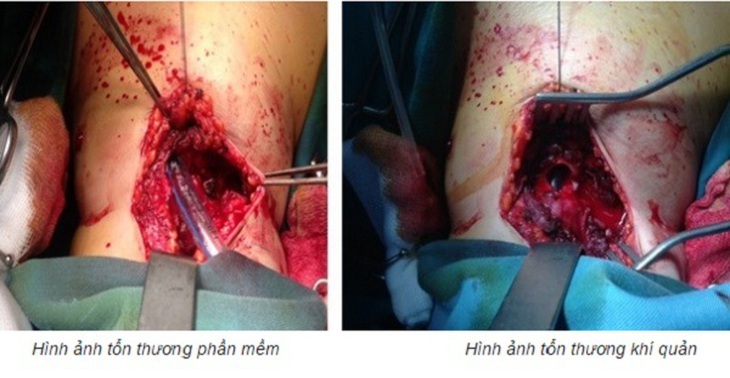 đứt khí quản