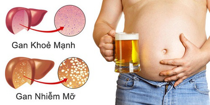 gan nhiễm mỡ