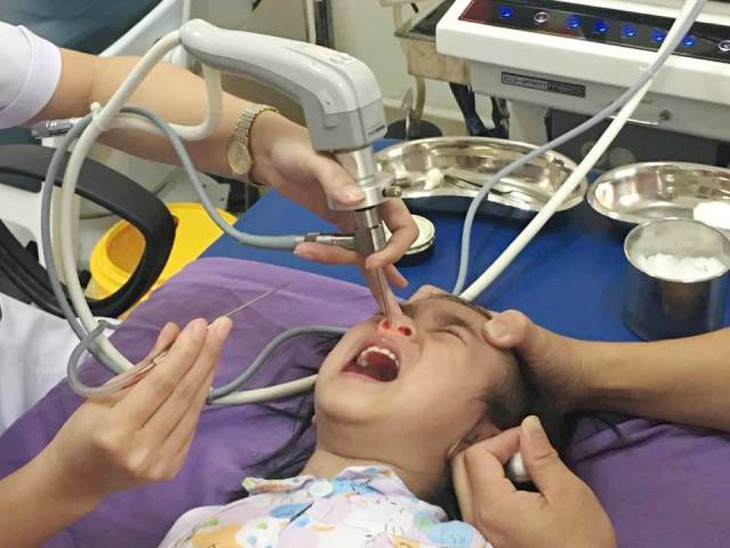 Cục pin điện tử 'chui' vào mũi bé gái 3 tuổi