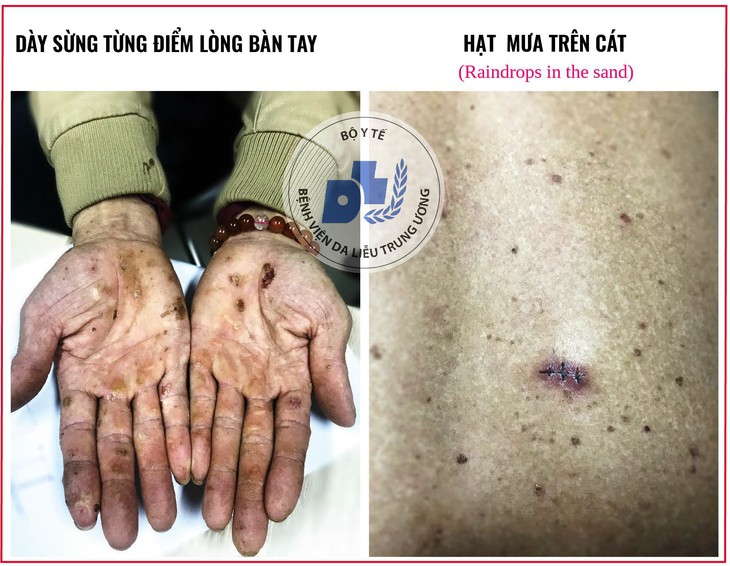 Cảnh báo nhiễm độc thạch tín gây ung thư da mà không hề hay biết