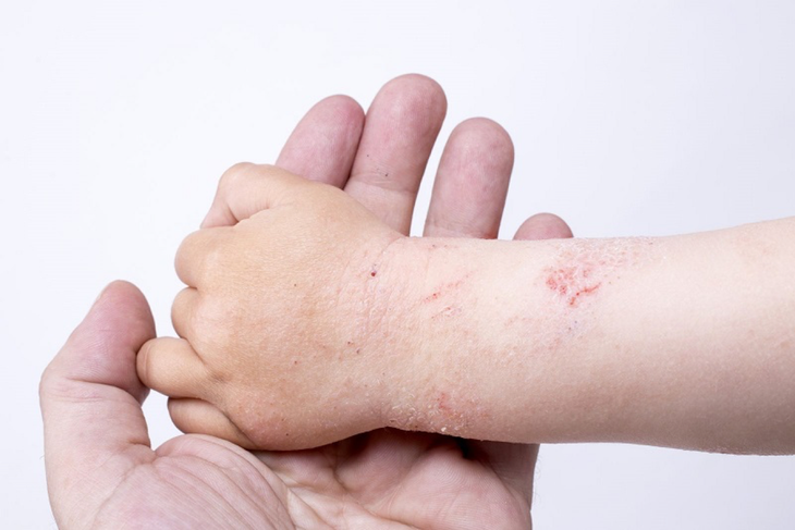 Viêm da cơ địa: Những điều cần biết
