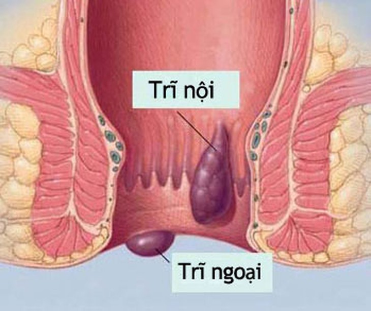Các phương pháp điều trị bệnh trĩ ngoại