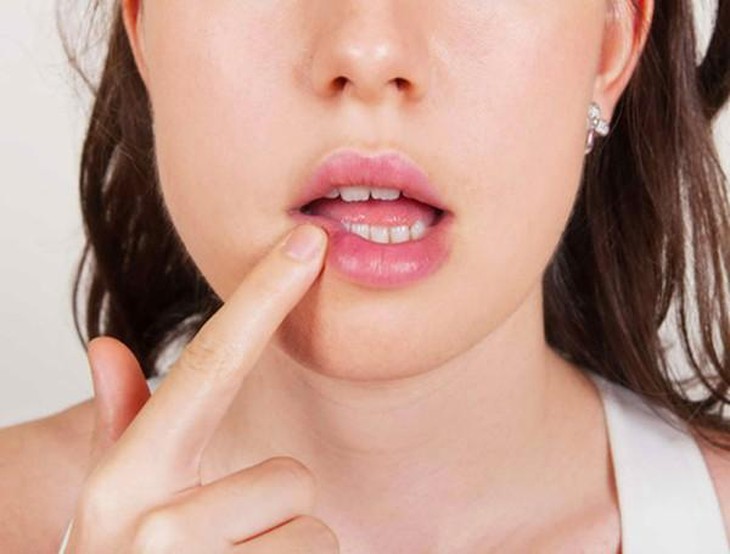 Điều trị nhiệt miệng đúng cách để tận hưởng trọn vẹn cuộc sống