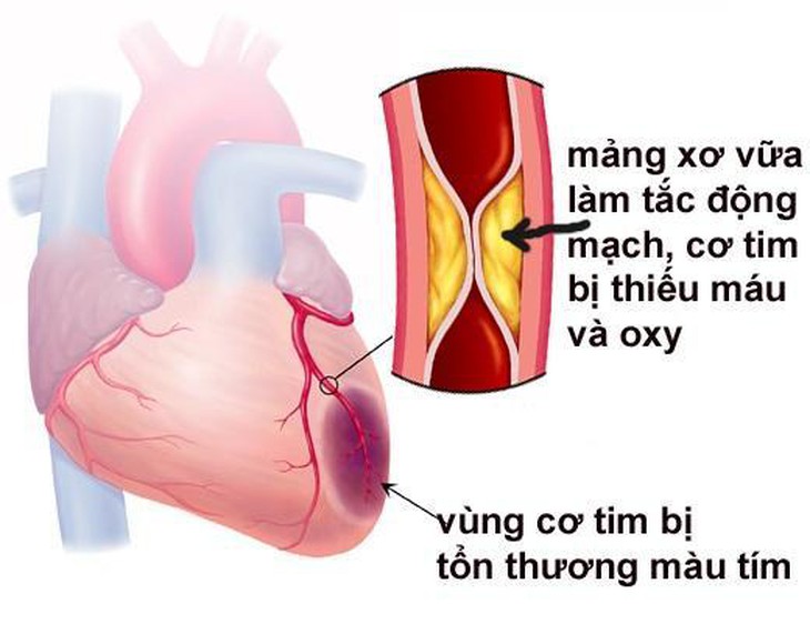 Mỡ máu cao tăng nguy cơ tai biến, đột quỵ